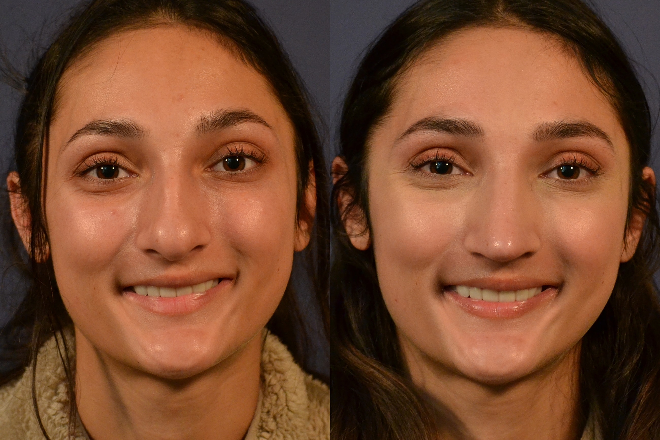 Before and after skin care treatment photo.