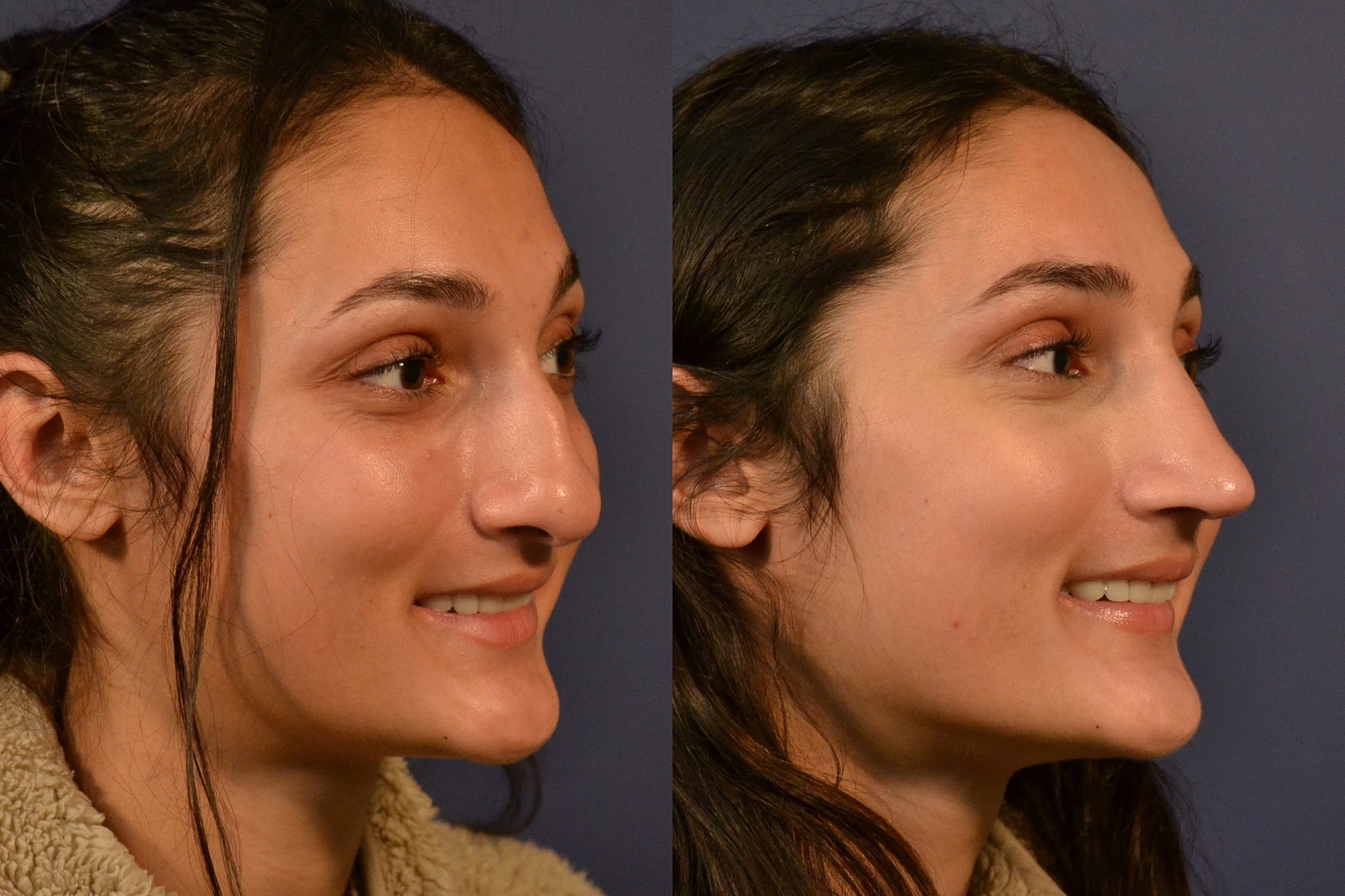 Profile comparison of a woman's facial features.