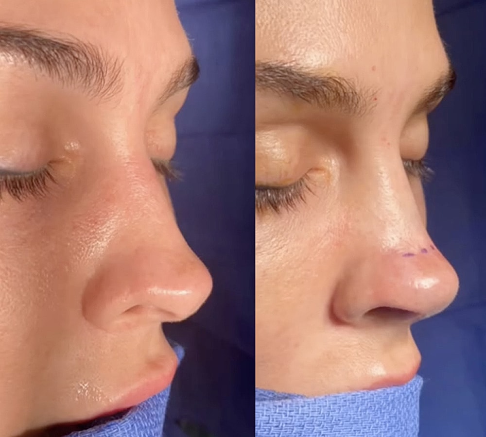 Before and after nose contouring treatment.