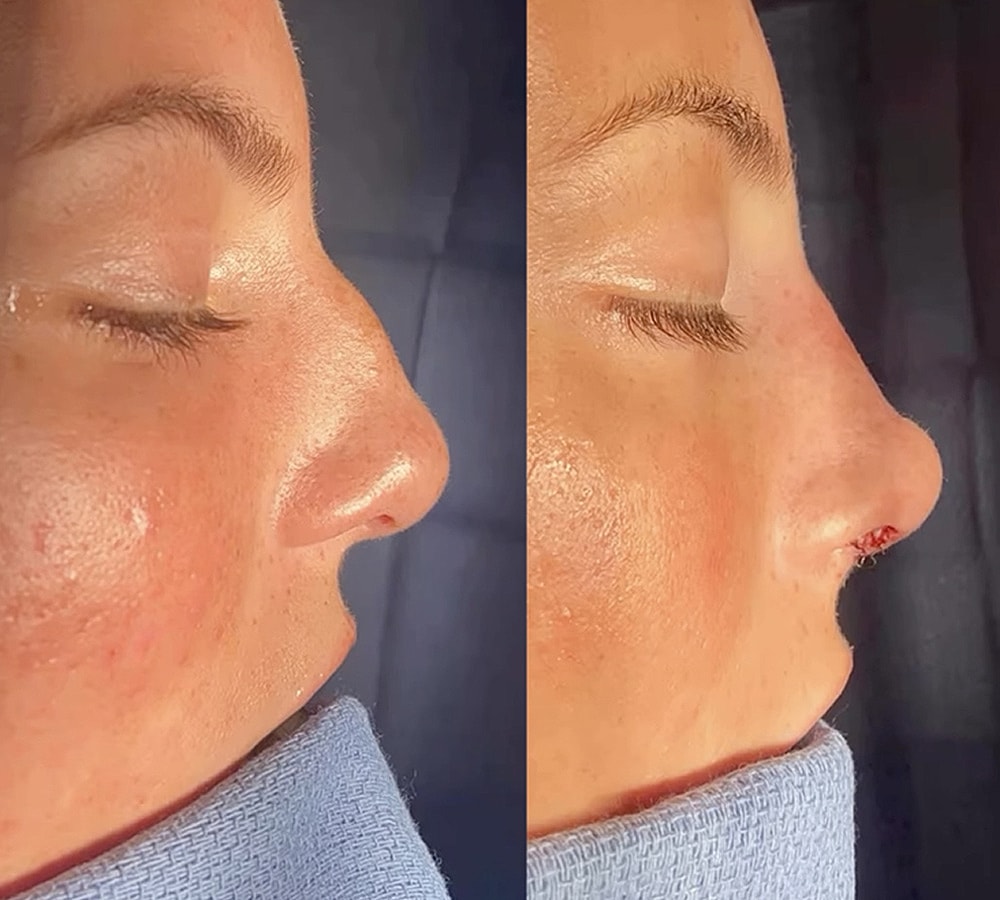 Before and after rhinoplasty procedure images.