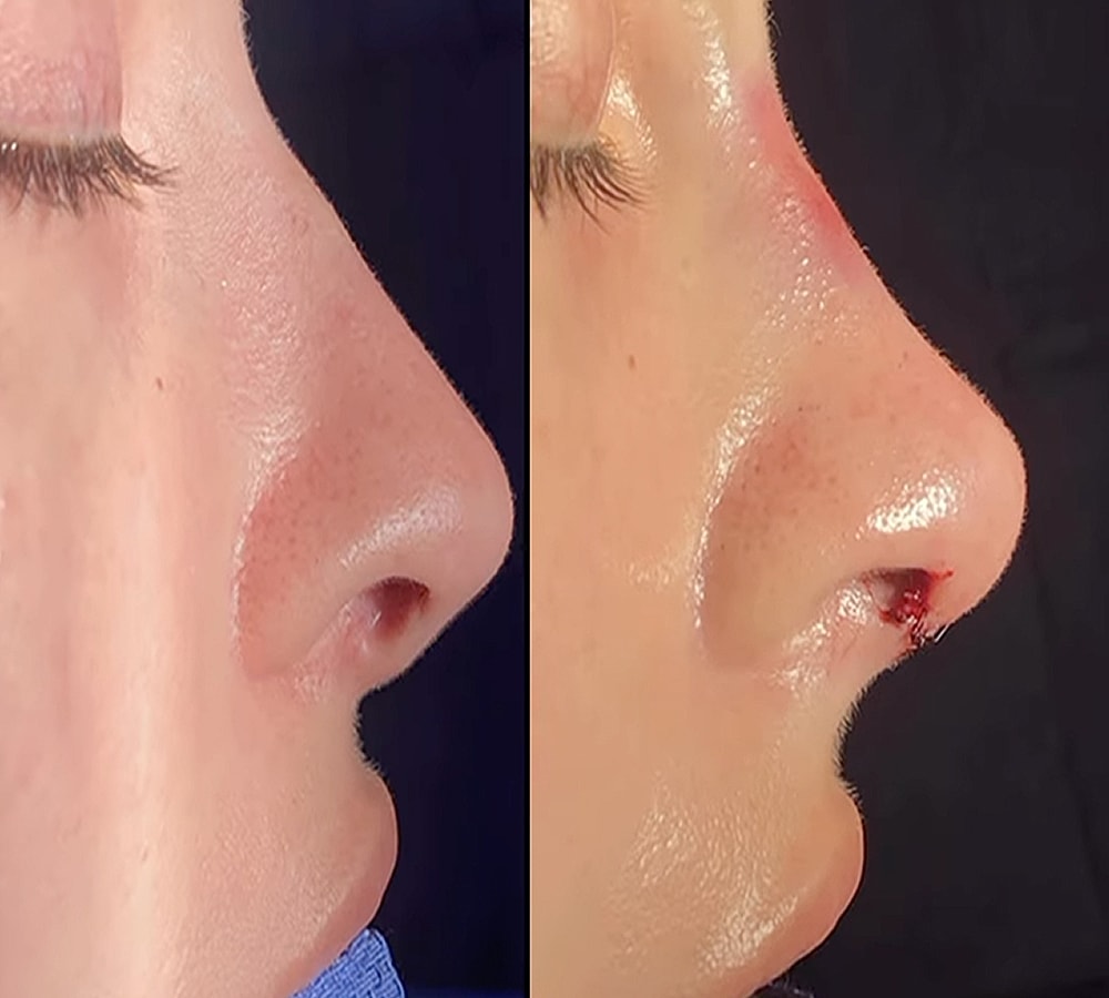 Before and after nose injury comparison.
