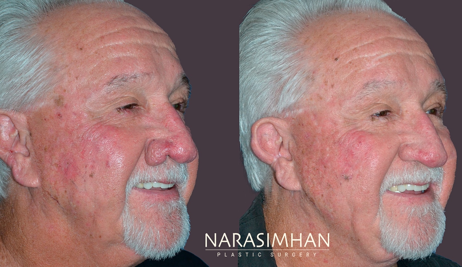 Rhinophyma Removal Before & After