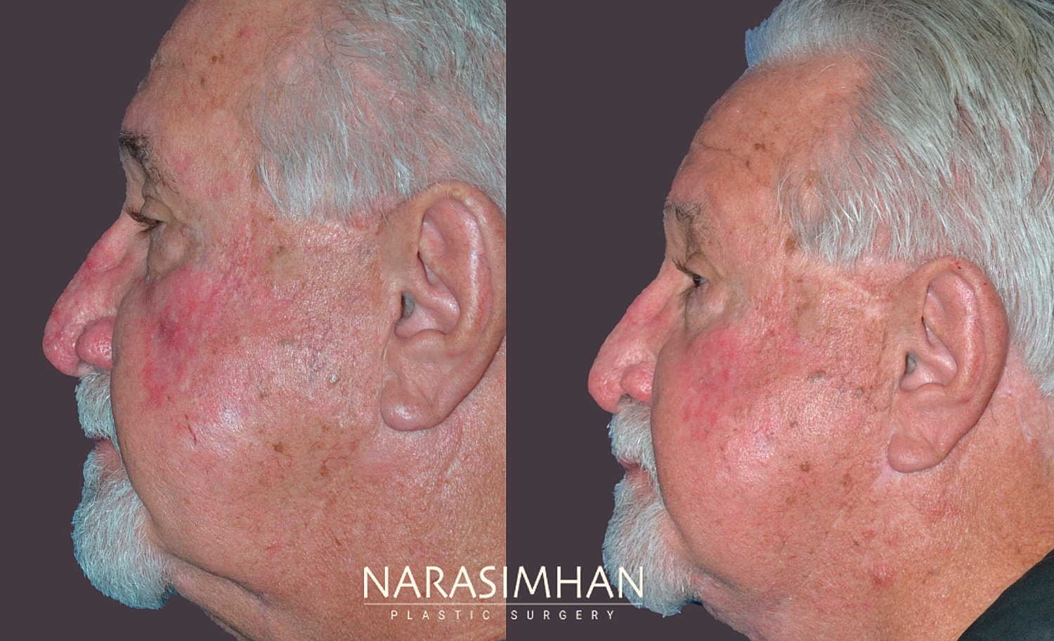 Rhinophyma Removal Before & After