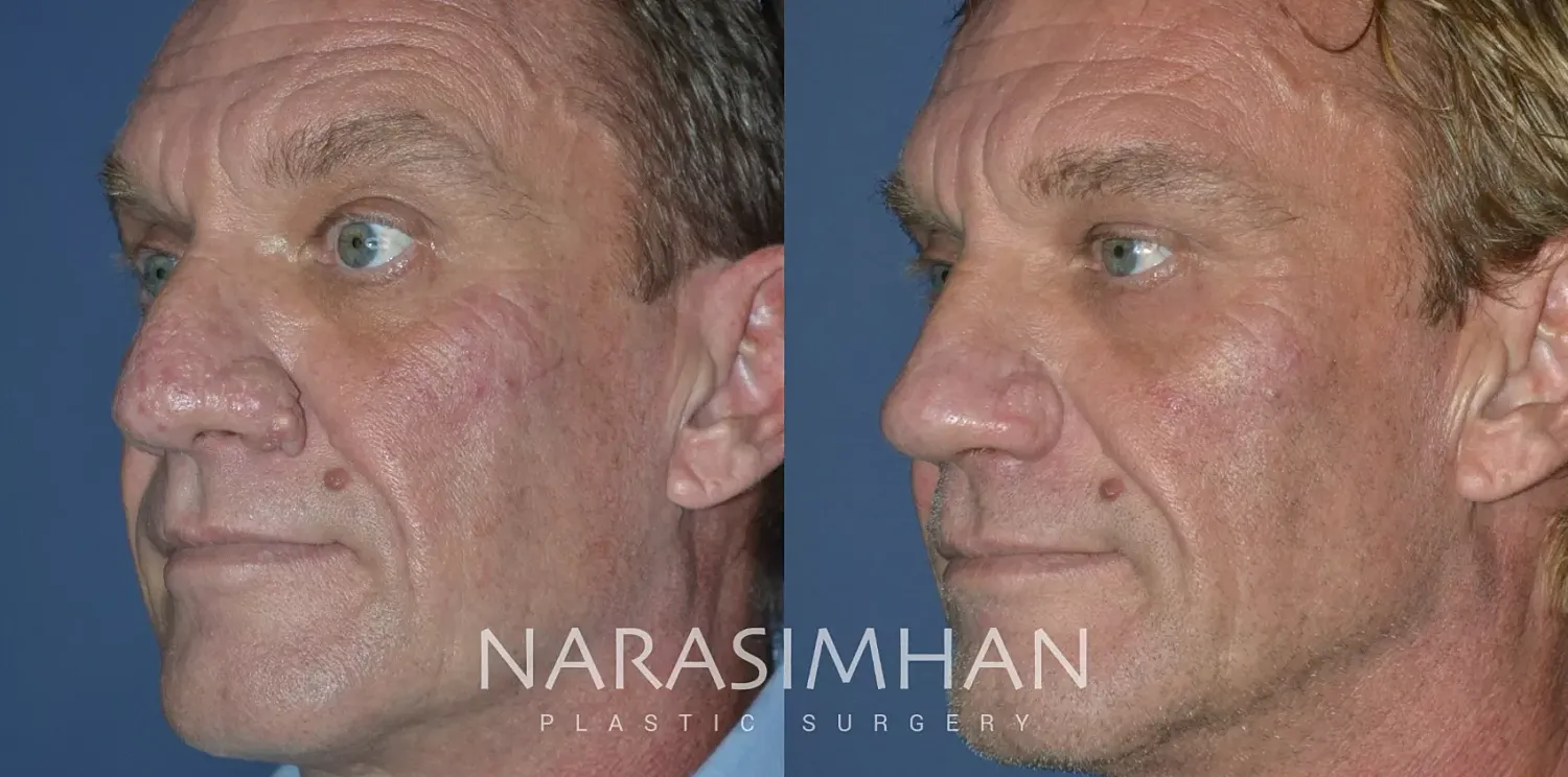 Rhinophyma Removal Before & After