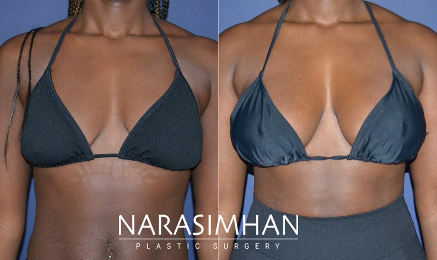 Breast Lift Mastopexy Before & After