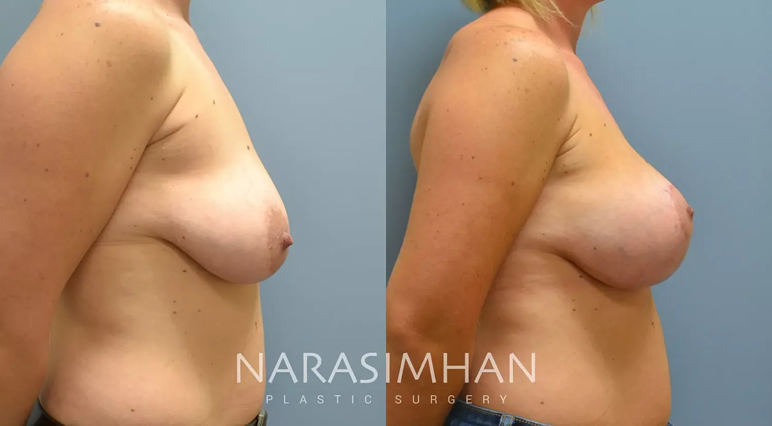 Breast Lift Mastopexy Before & After
