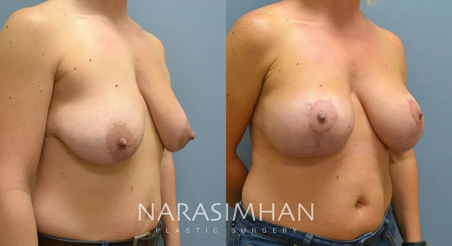 Breast Lift Mastopexy Before & After