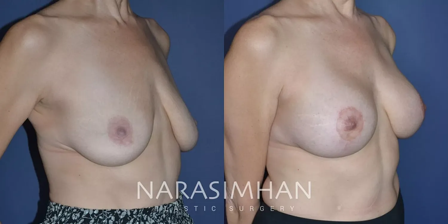Breast Lift Mastopexy Before & After