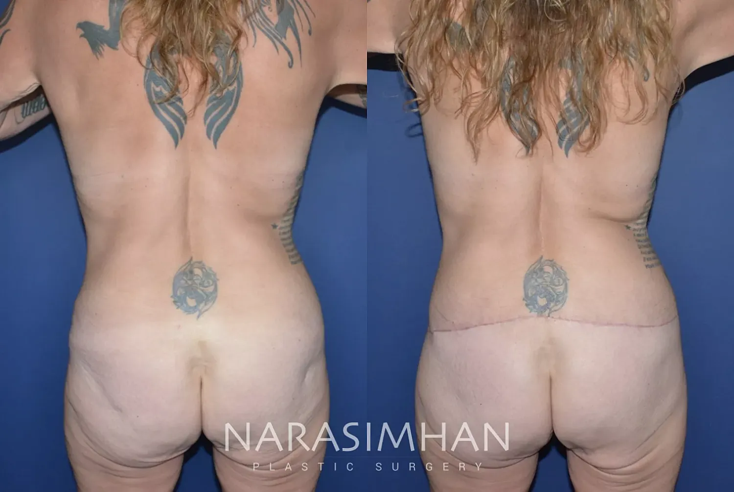Breast Lift Mastopexy Before & After