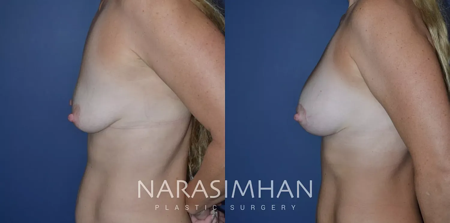 Breast Lift Mastopexy Before & After