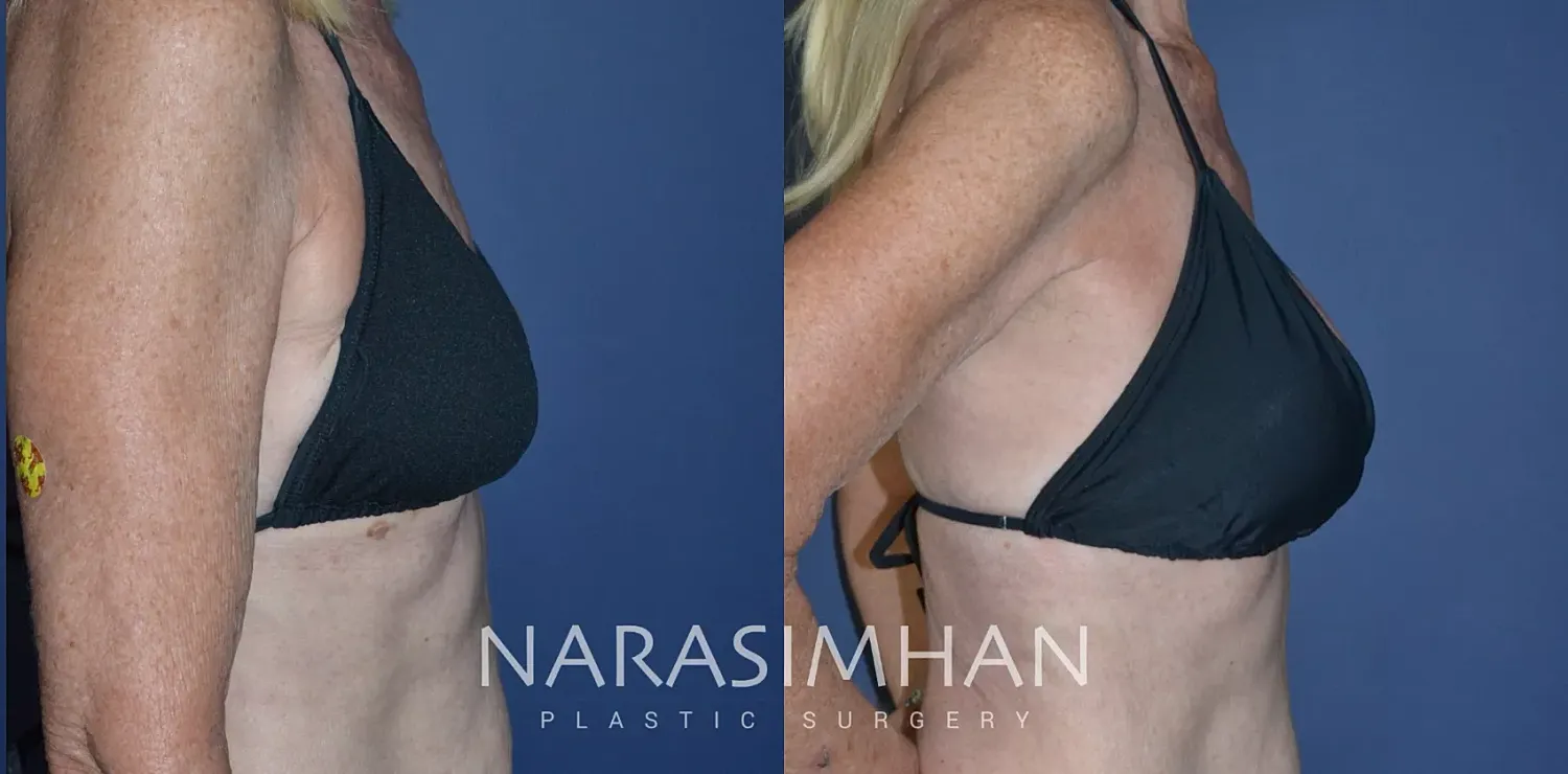 Breast Lift Mastopexy Before & After