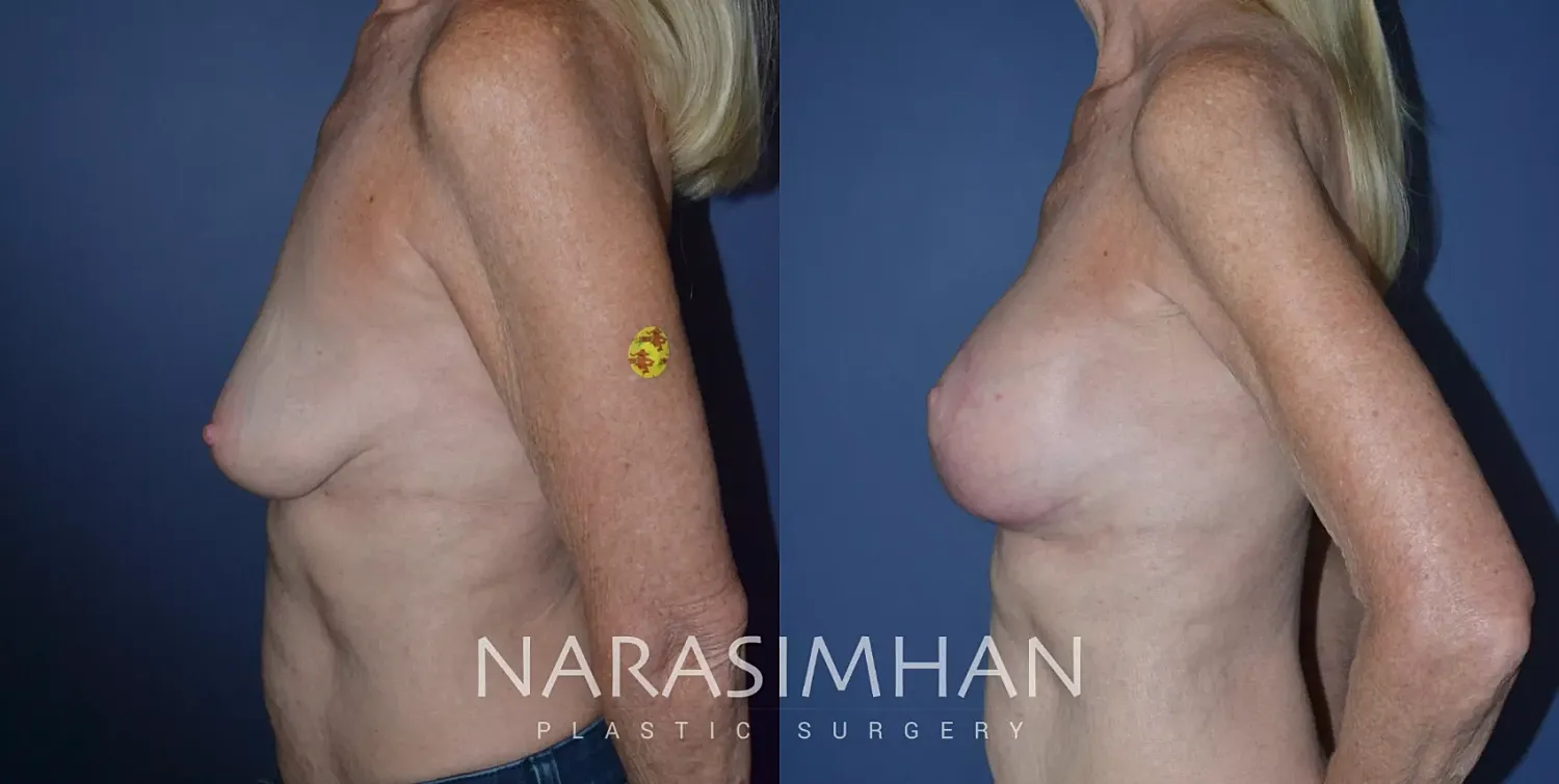 Breast Lift Mastopexy Before & After