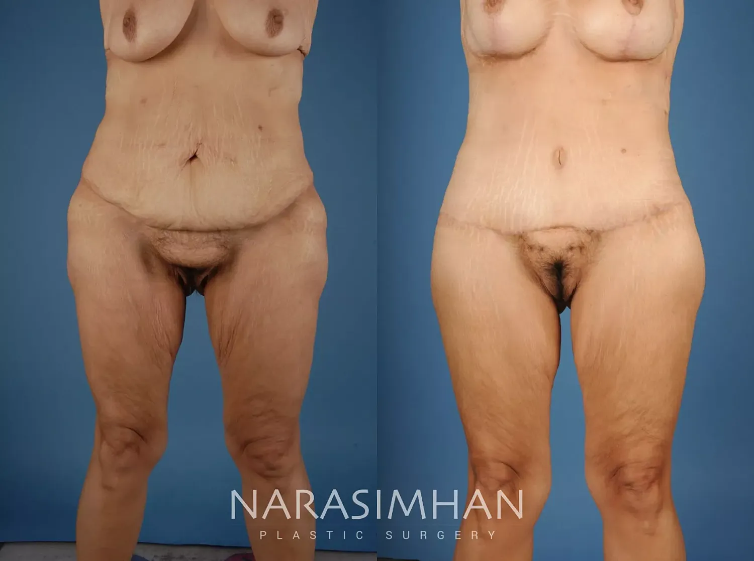 Breast Lift Mastopexy Before & After