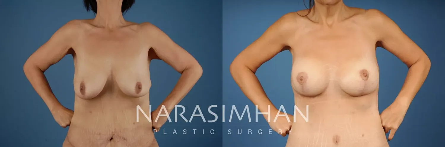 Breast Lift Mastopexy Before & After