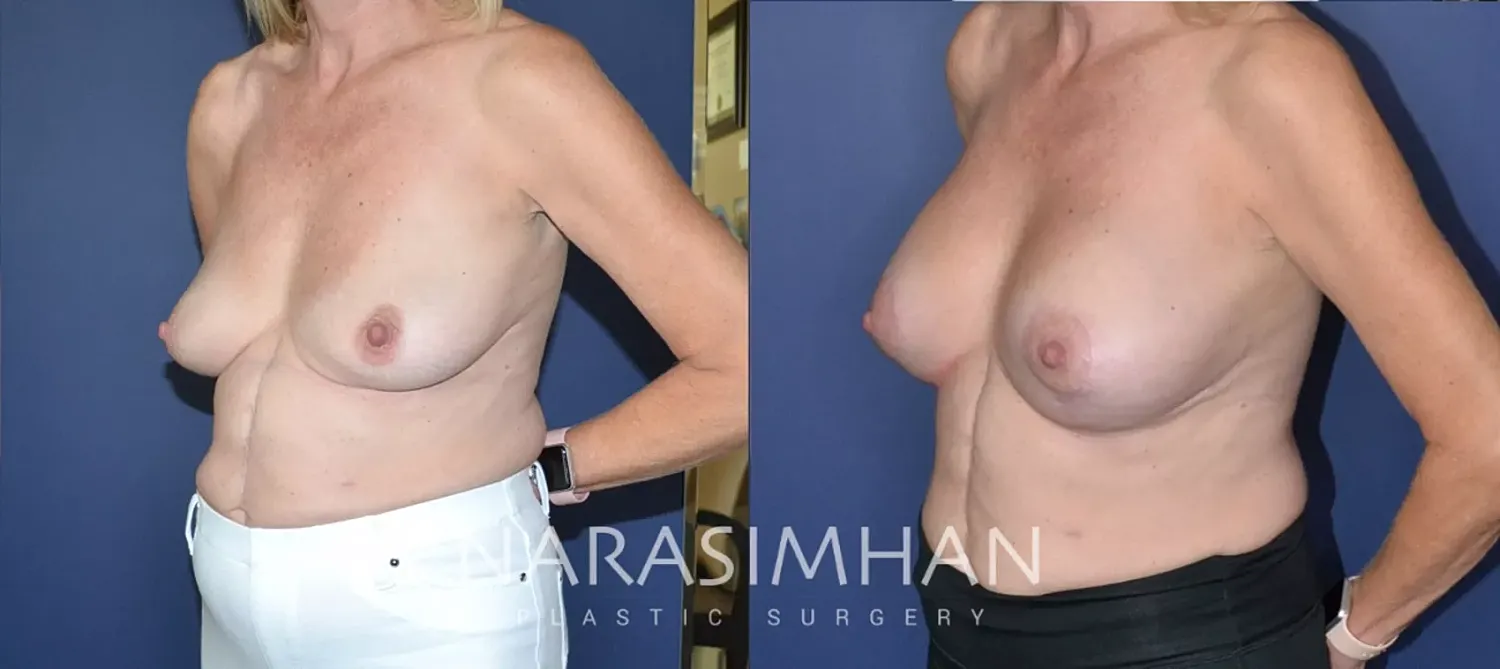 Breast Lift Mastopexy Before & After