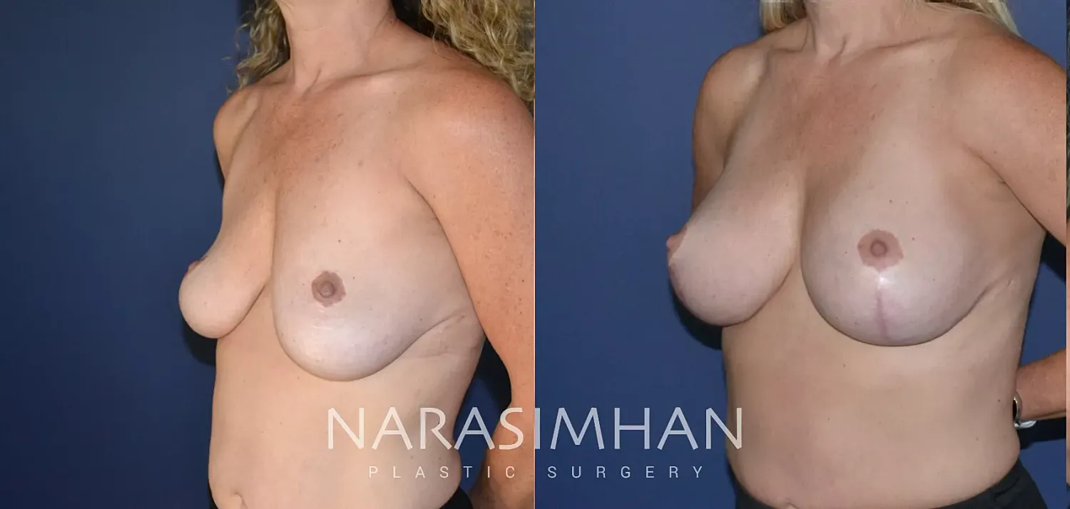 Breast Lift Mastopexy Before & After