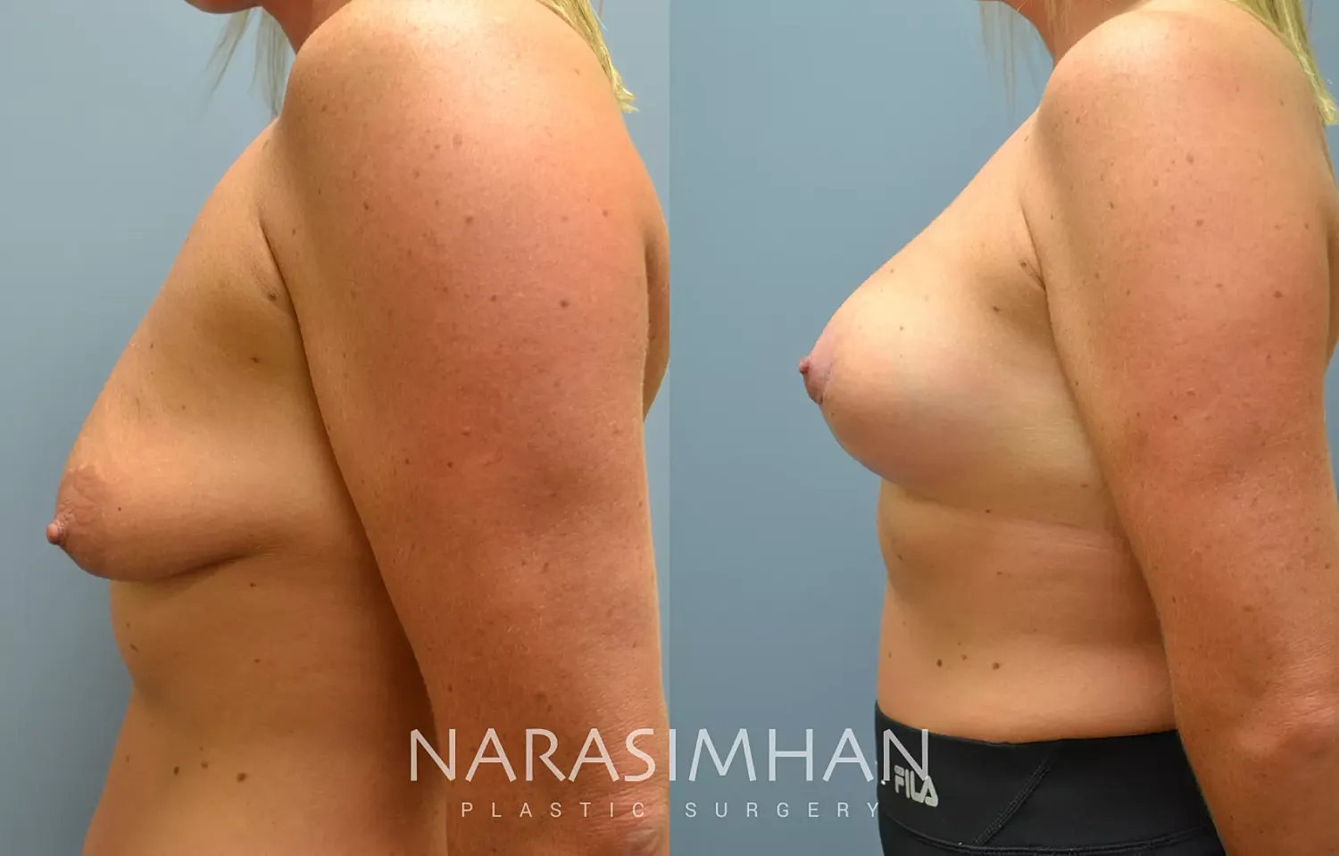 Breast Lift Mastopexy Before & After