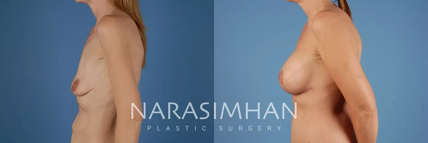 Breast Lift Mastopexy Before & After