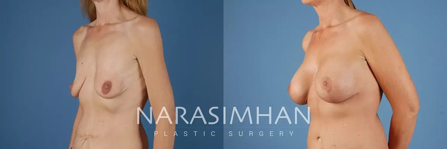 Breast Lift Mastopexy Before & After