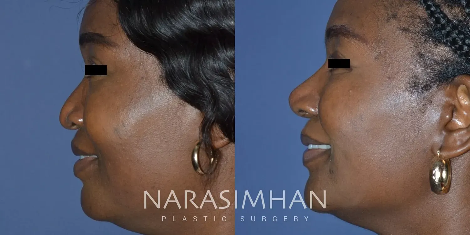 Ethnic Rhinoplasty Before & After