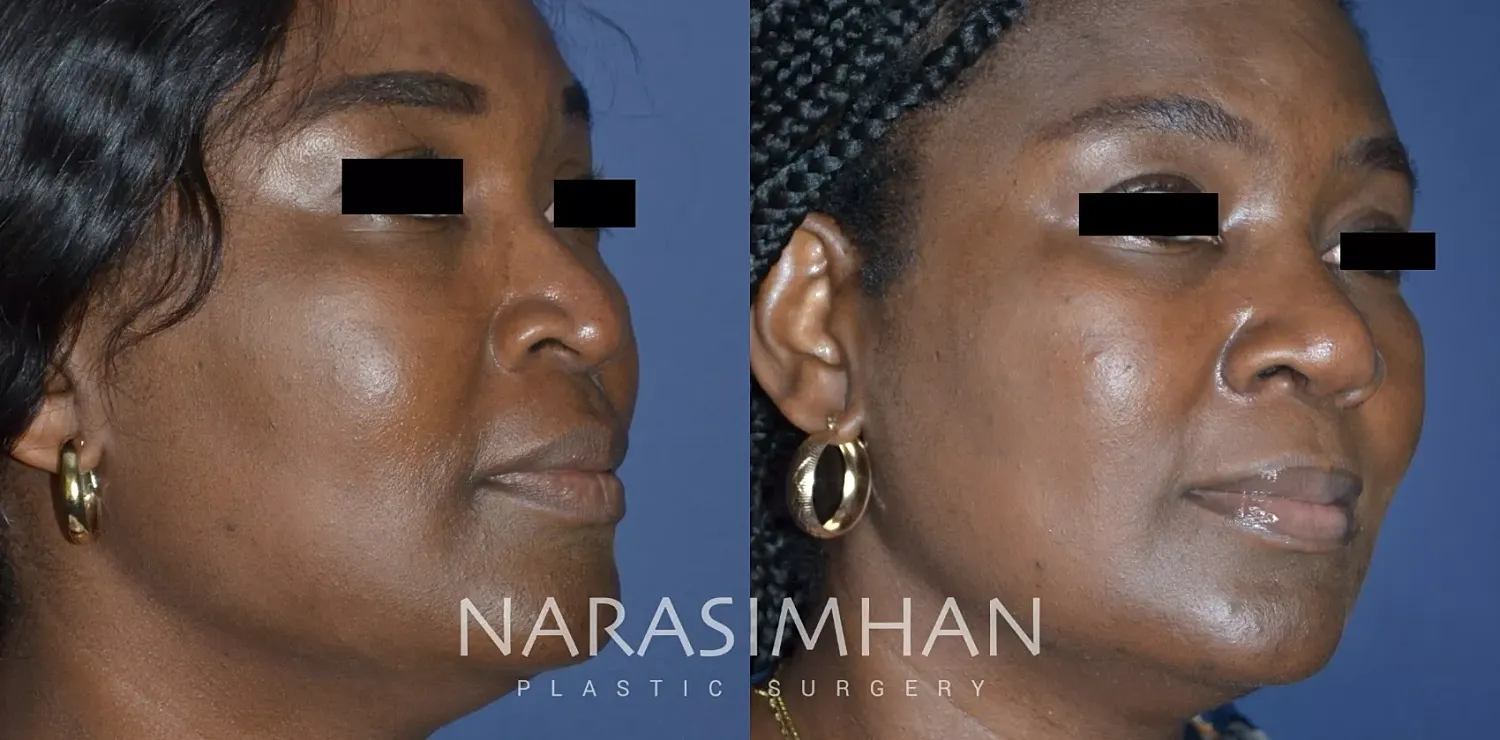 Ethnic Rhinoplasty Before & After