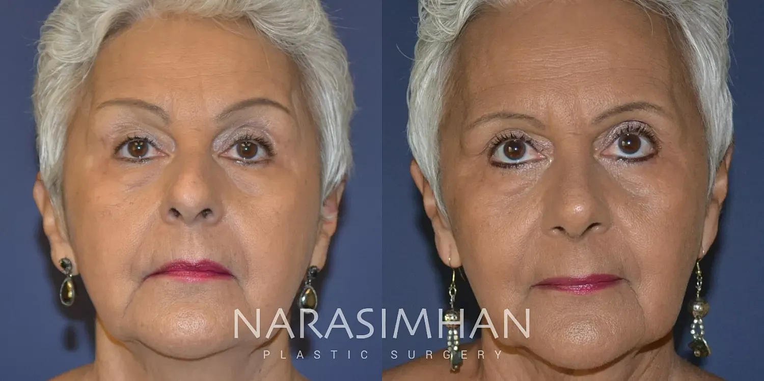 Ethnic Rhinoplasty Before & After