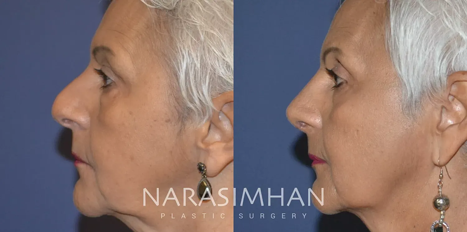 Ethnic Rhinoplasty Before & After