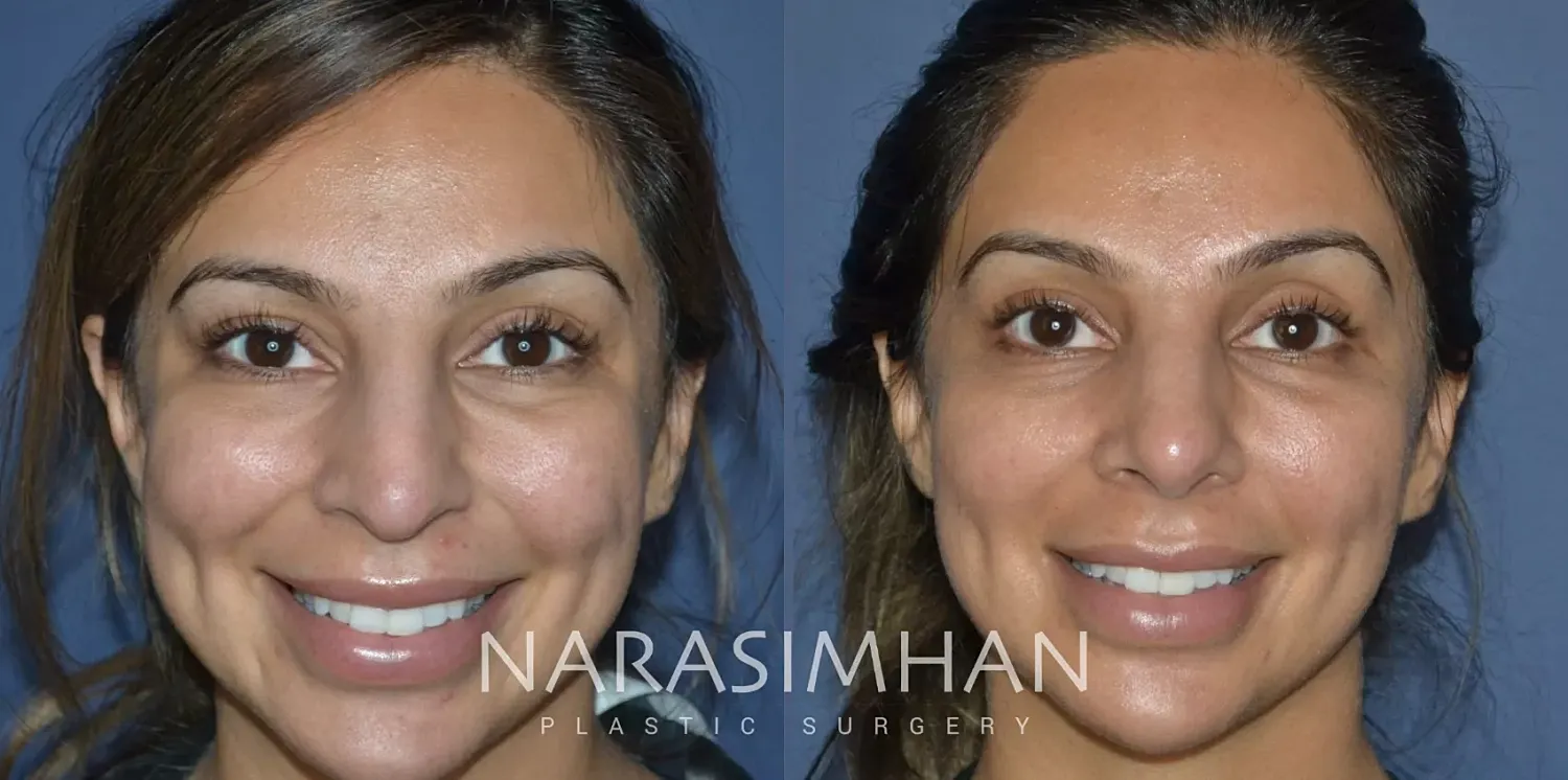 Ethnic Rhinoplasty Before & After