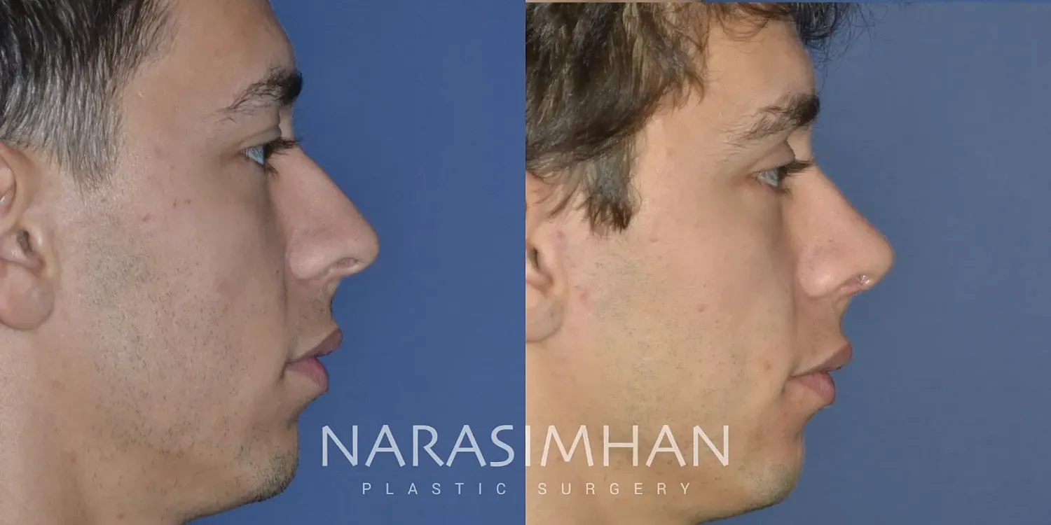 Ethnic Rhinoplasty Before & After