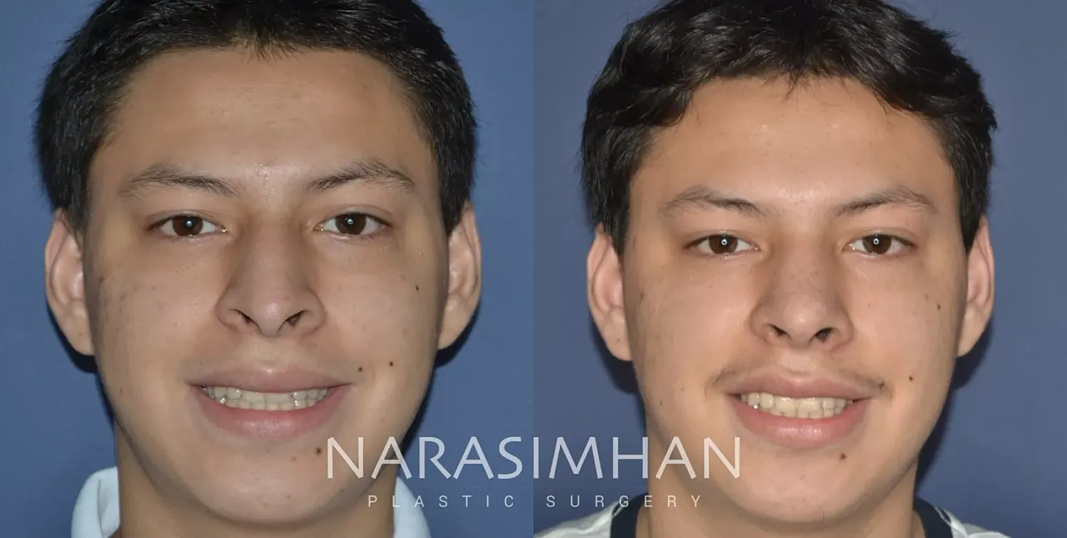 Ethnic Rhinoplasty Before & After