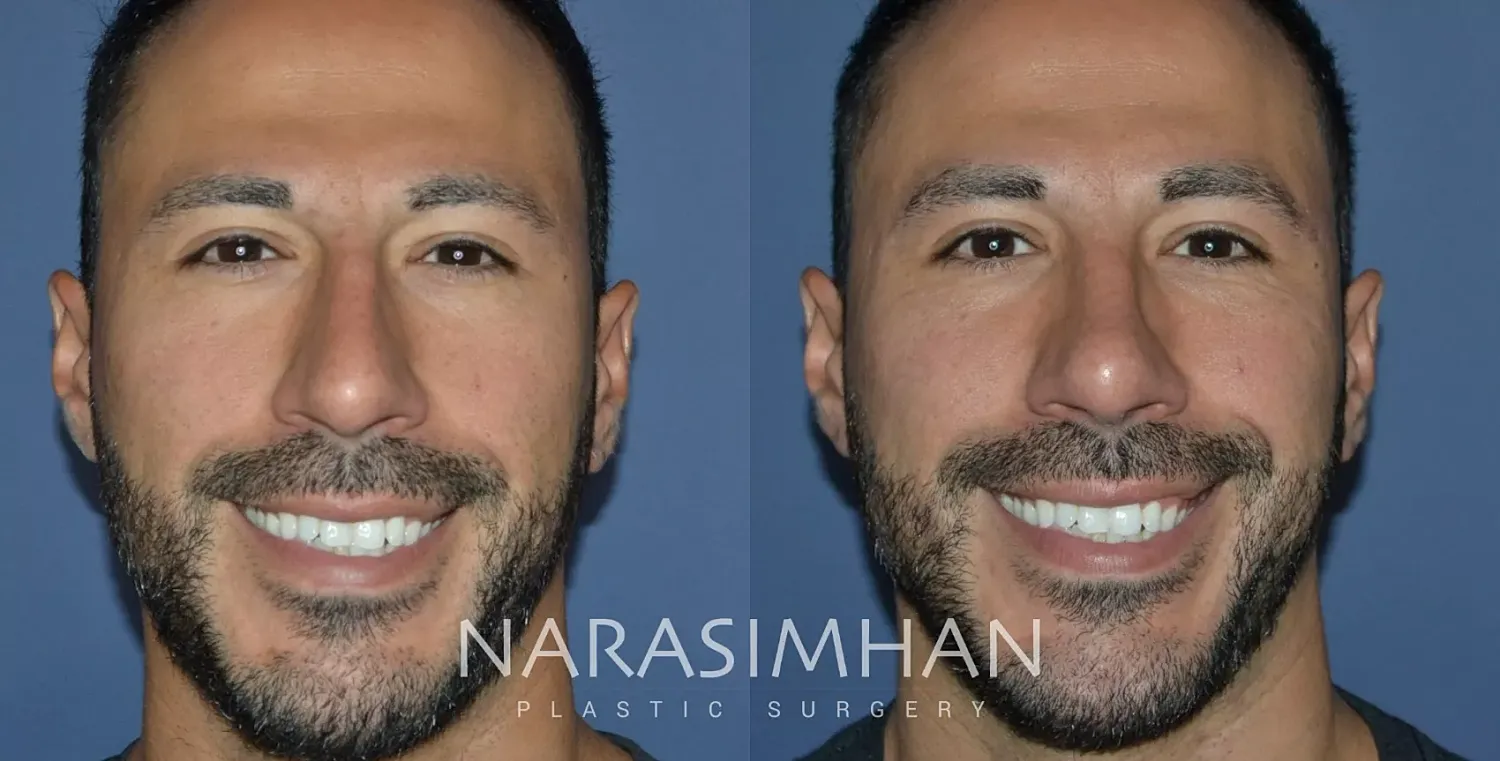 Ethnic Rhinoplasty Before & After