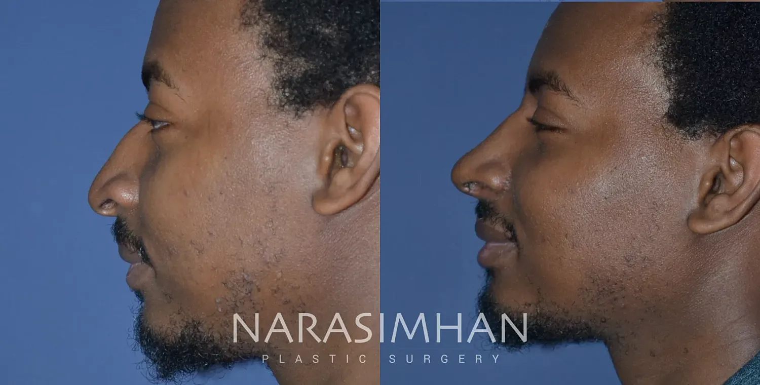Ethnic Rhinoplasty Before & After