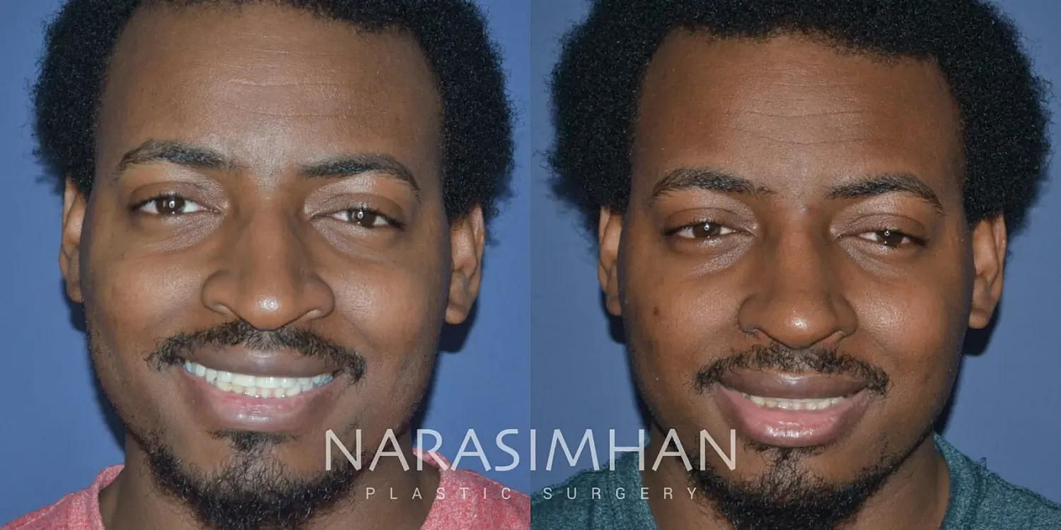 Ethnic Rhinoplasty Before & After