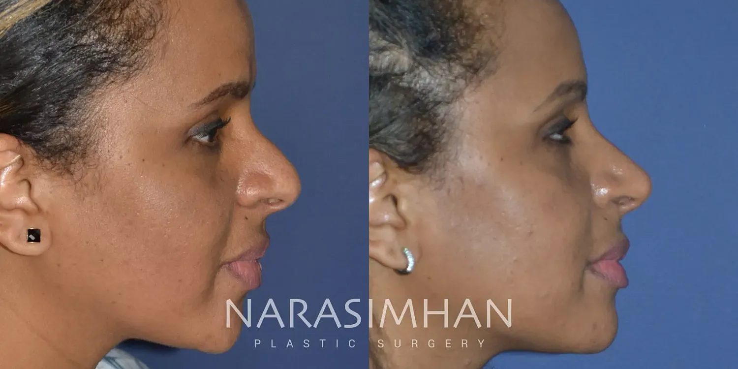 Ethnic Rhinoplasty Before & After