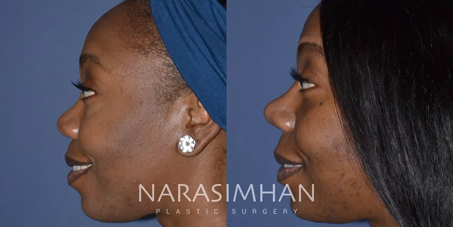 Ethnic Rhinoplasty Before & After