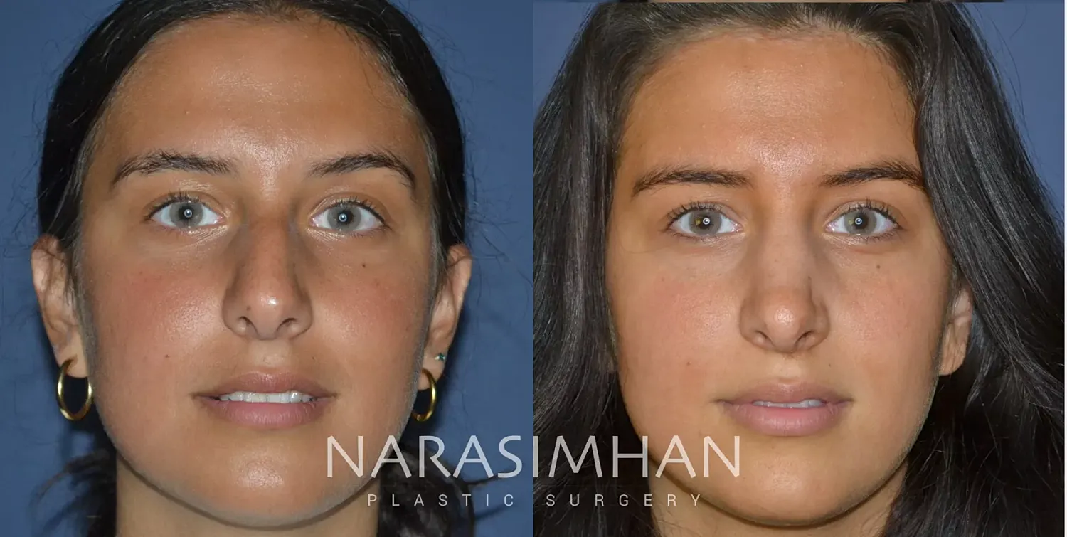 Ethnic Rhinoplasty Before & After