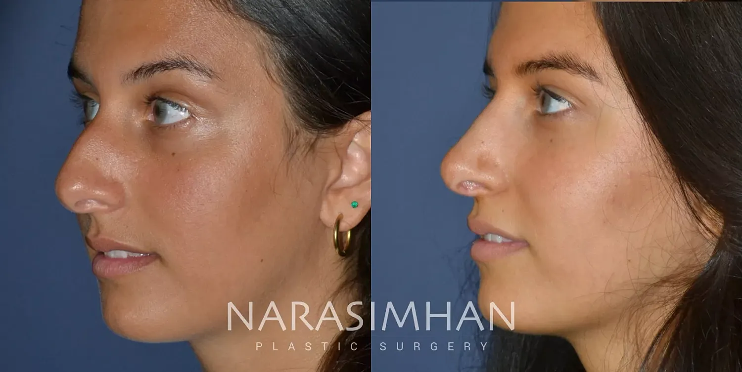 Ethnic Rhinoplasty Before & After