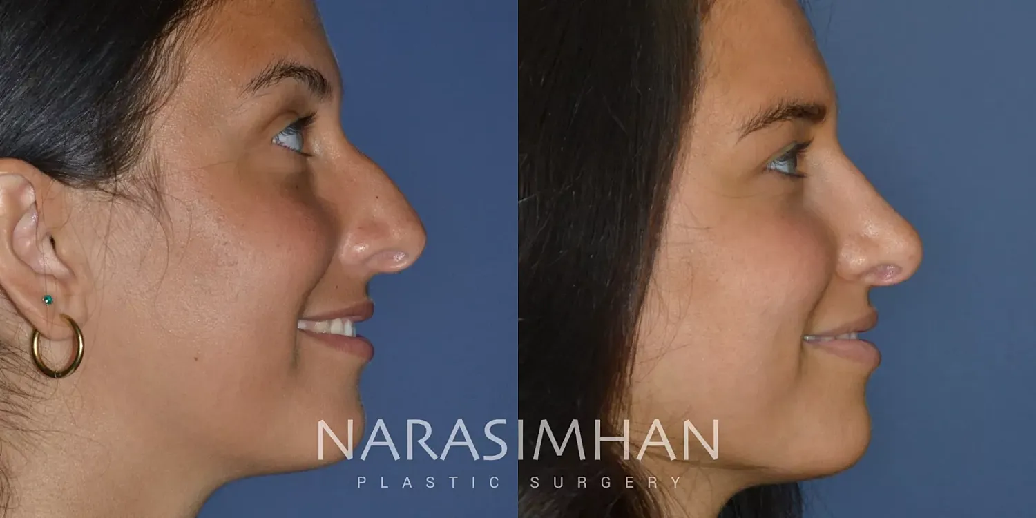 Ethnic Rhinoplasty Before & After