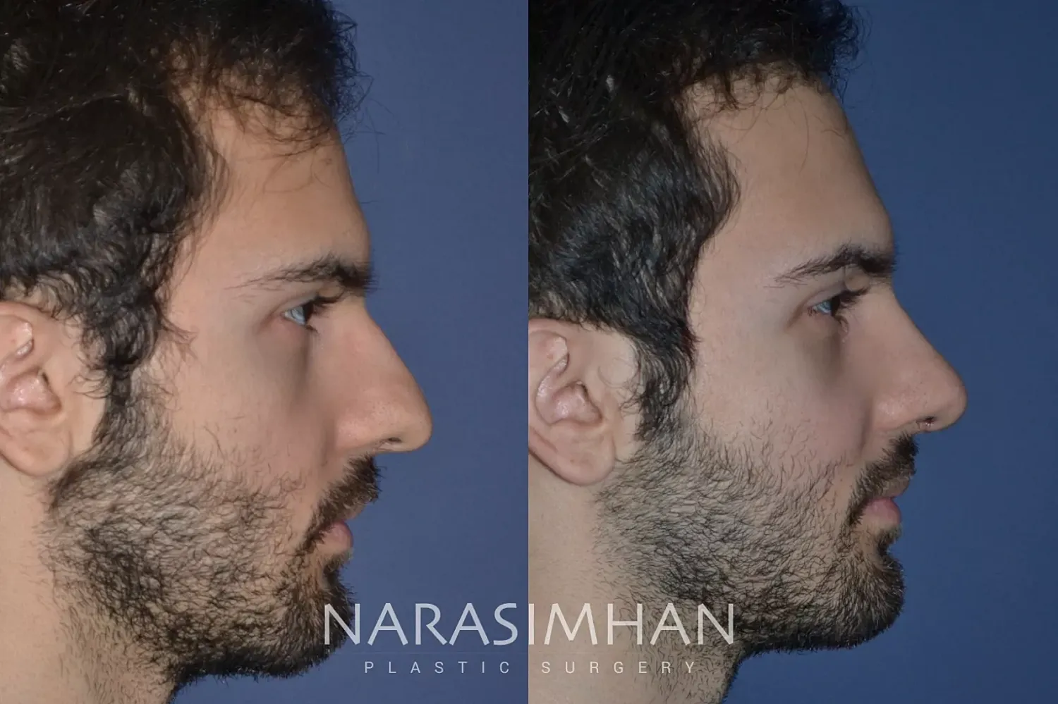 Ethnic Rhinoplasty Before & After