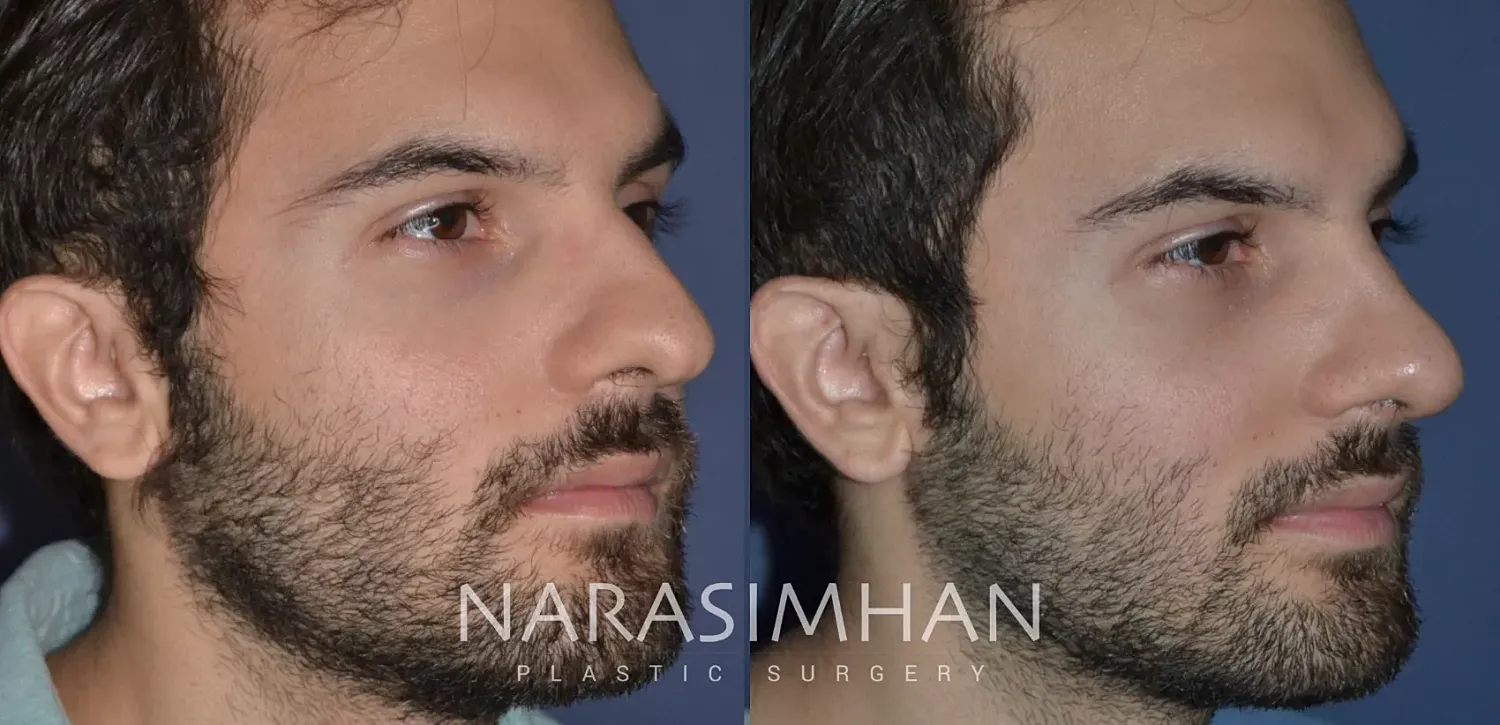 Ethnic Rhinoplasty Before & After
