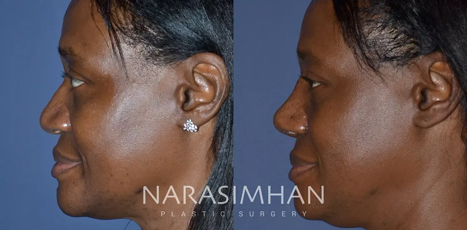Ethnic Rhinoplasty Before & After