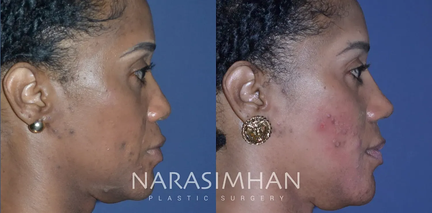 Ethnic Rhinoplasty Before & After