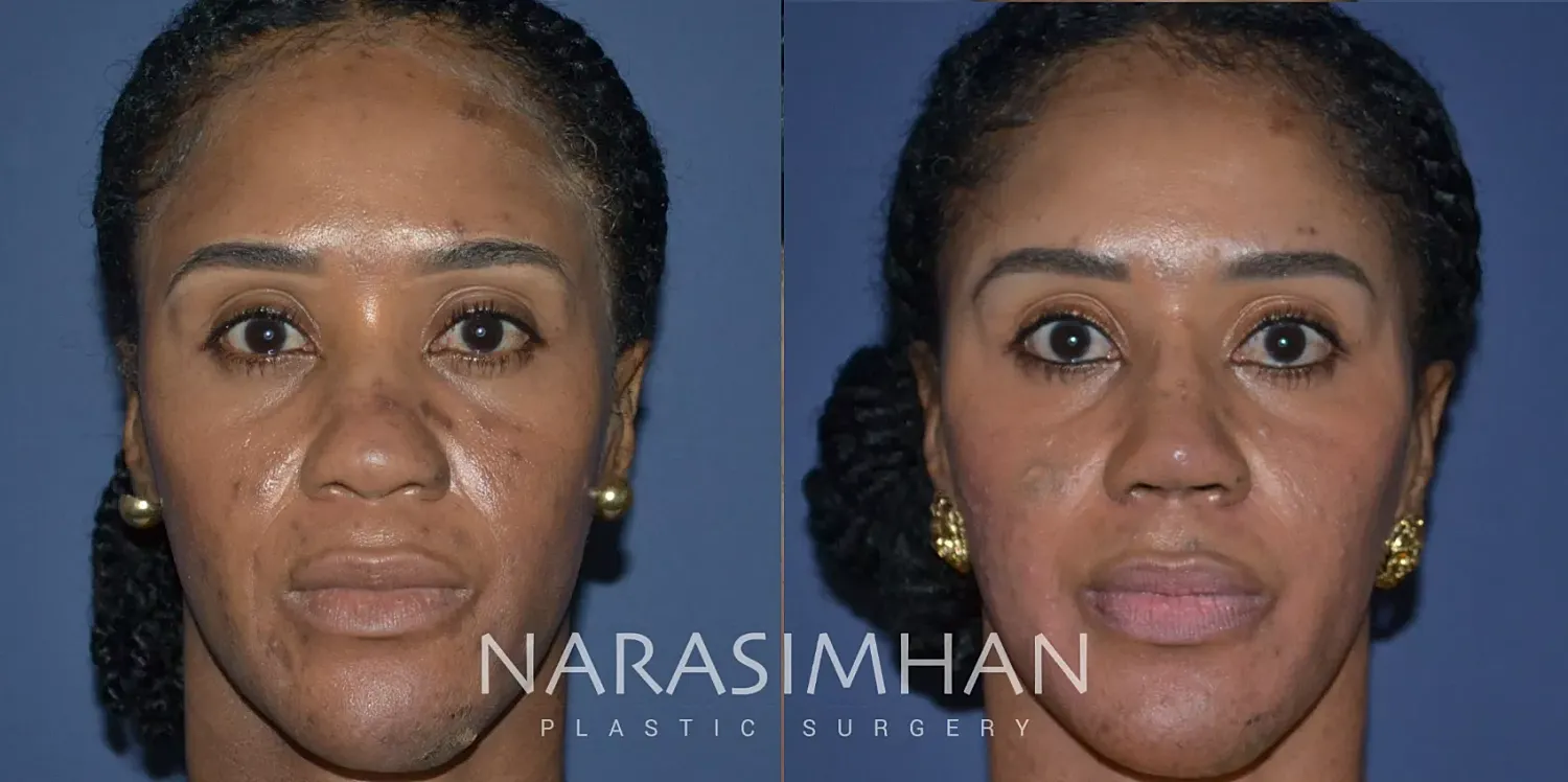 Ethnic Rhinoplasty Before & After