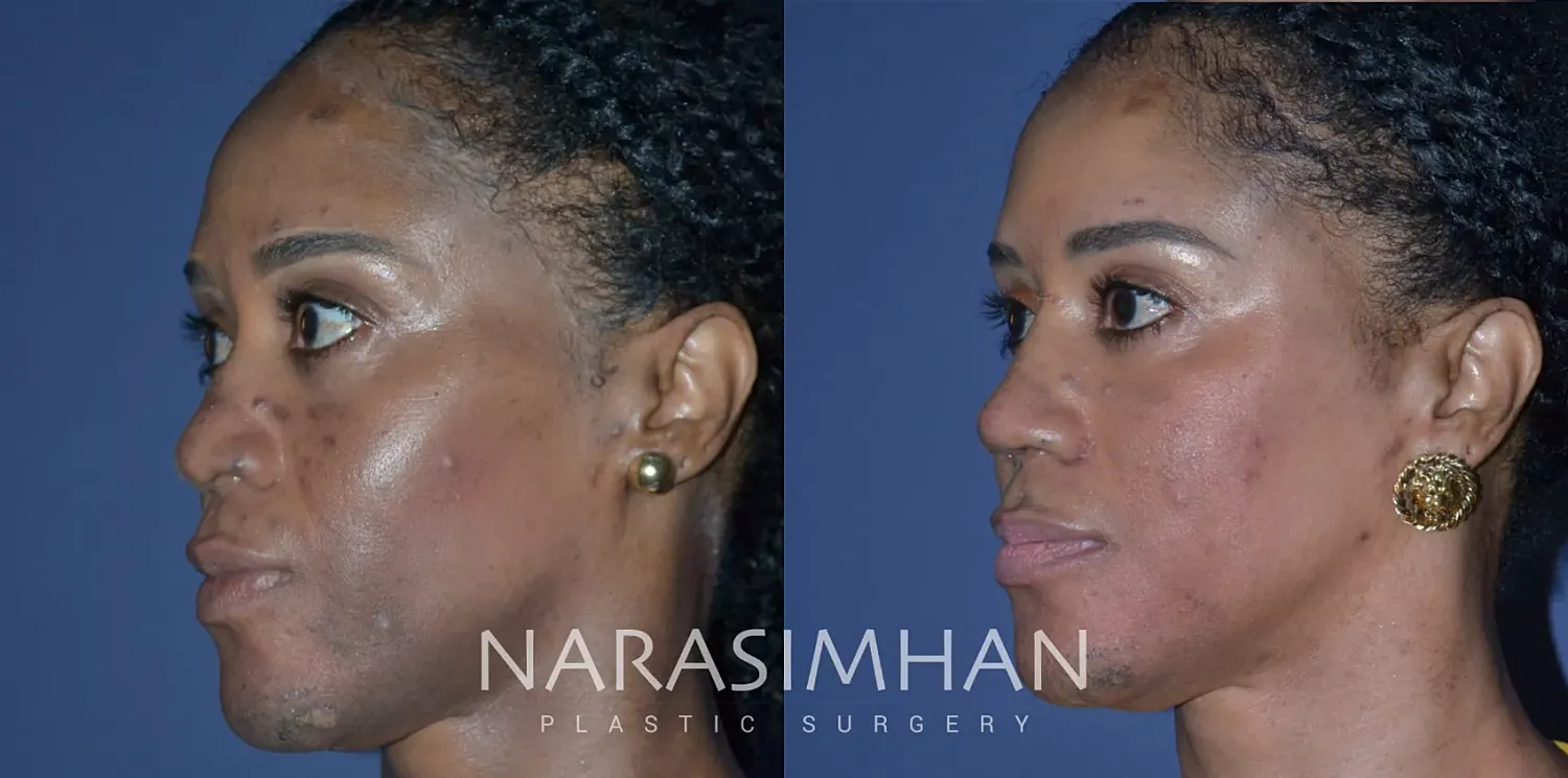 Ethnic Rhinoplasty Before & After