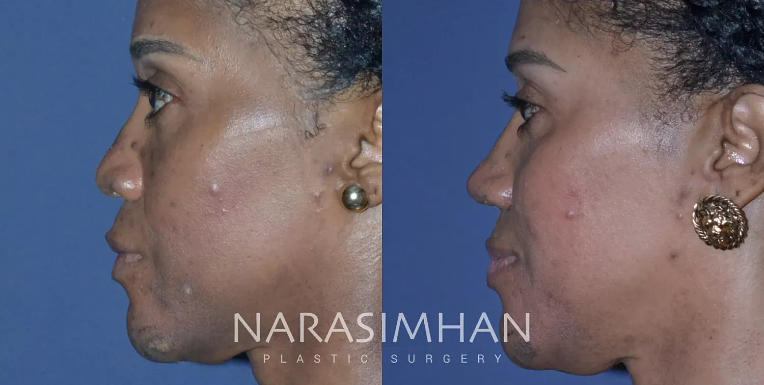 Ethnic Rhinoplasty Before & After