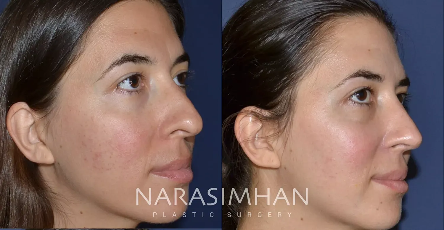 Ethnic Rhinoplasty Before & After