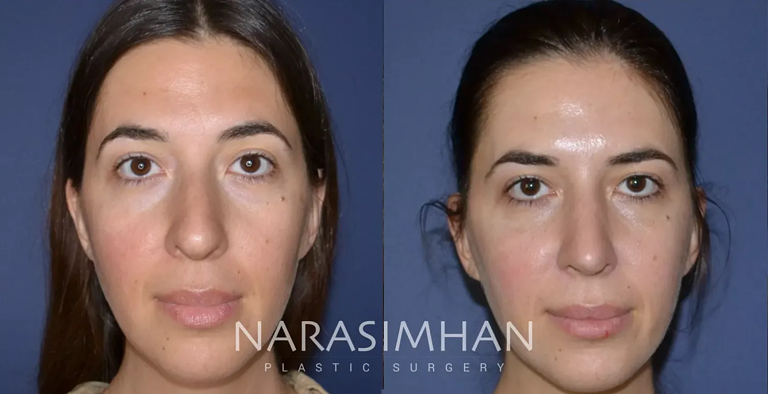 Ethnic Rhinoplasty Before & After