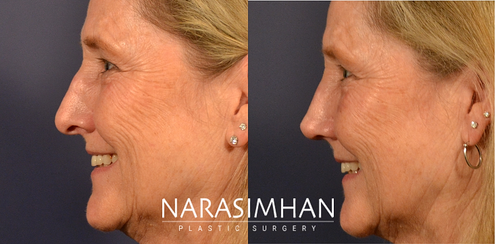 Ethnic Rhinoplasty Before & After