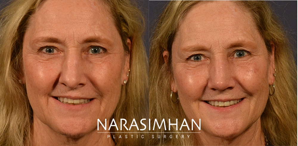 Ethnic Rhinoplasty Before & After