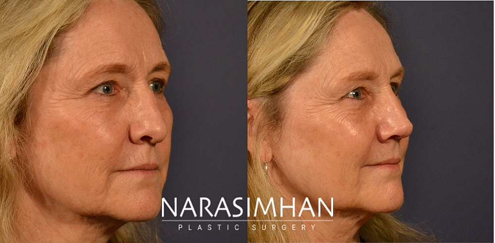 Ethnic Rhinoplasty Before & After